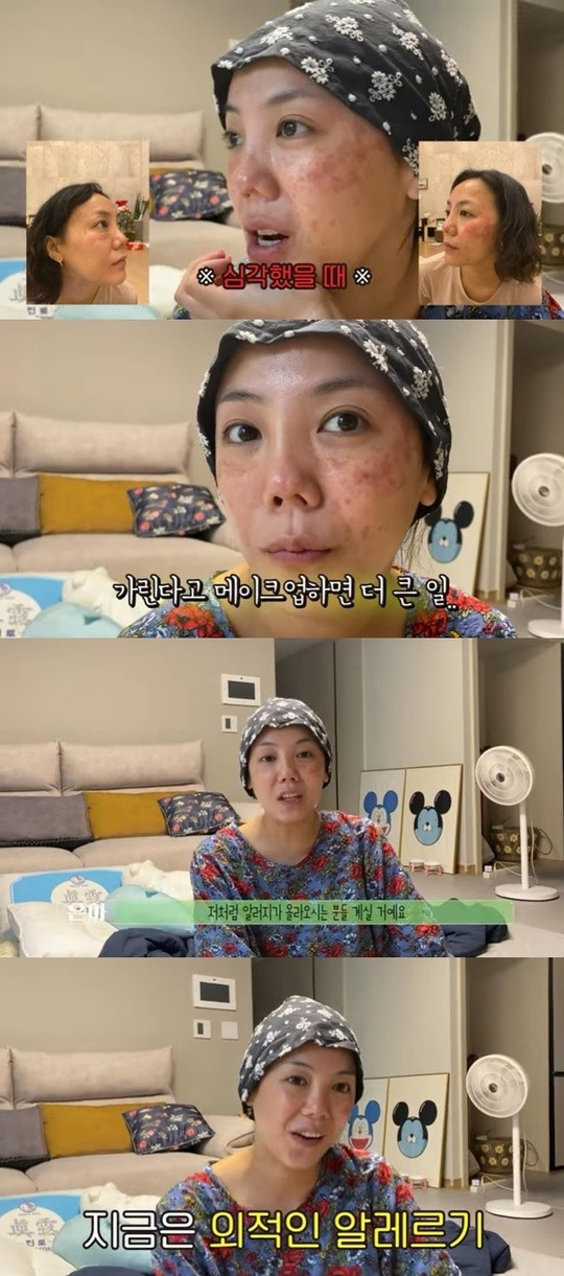 얼굴이 왜 이래… 고은아 피부 알레르기 '심각' 수준?