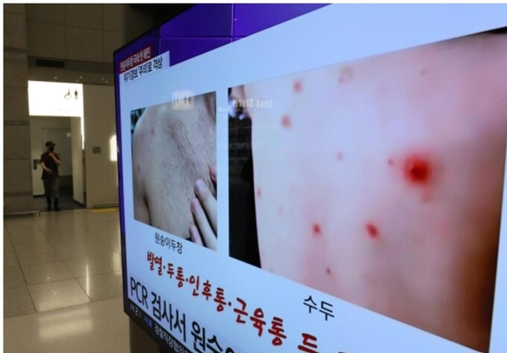 경기도, '원숭이두창' 비상대응 체계 가동…방역대책반·전담병원 등
