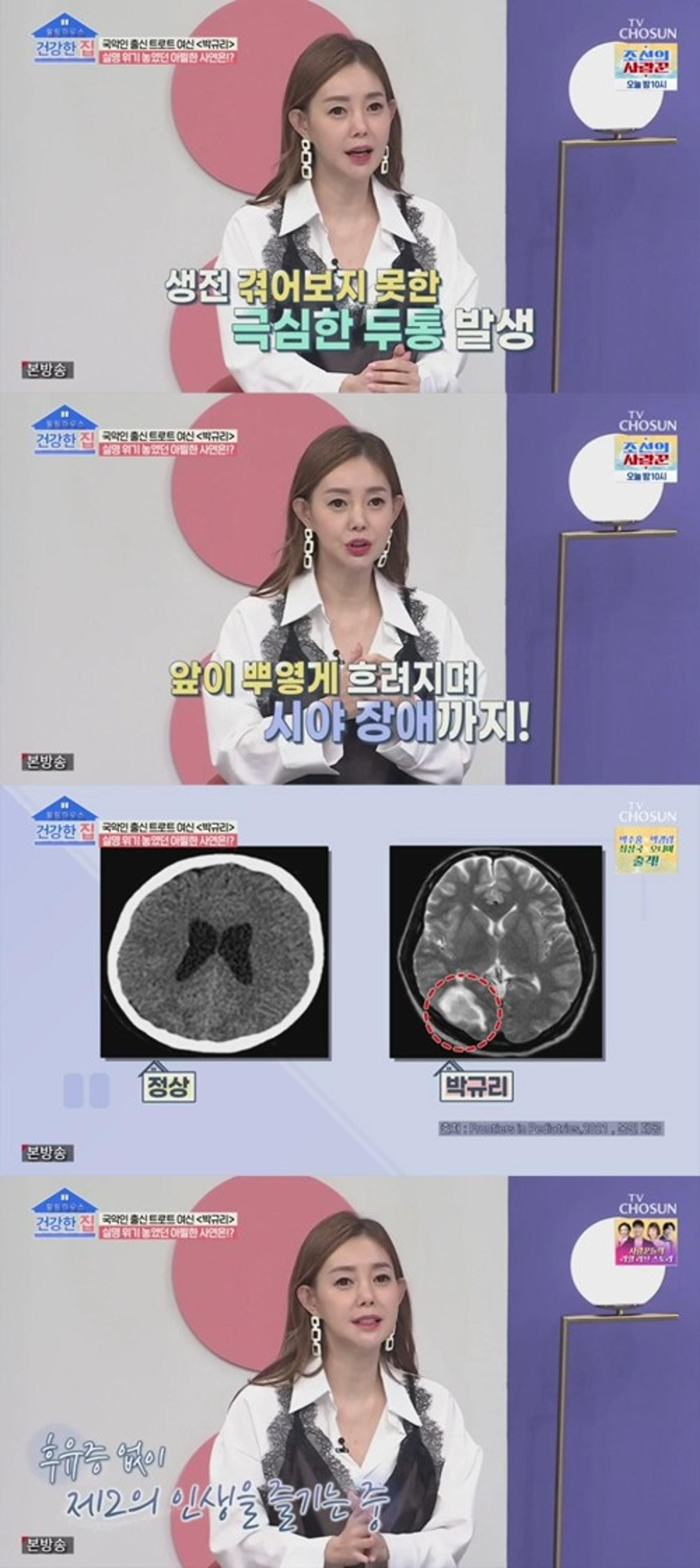 "뇌출혈로 눈 안보여"… 박규리, 생사 고비 넘겼다
