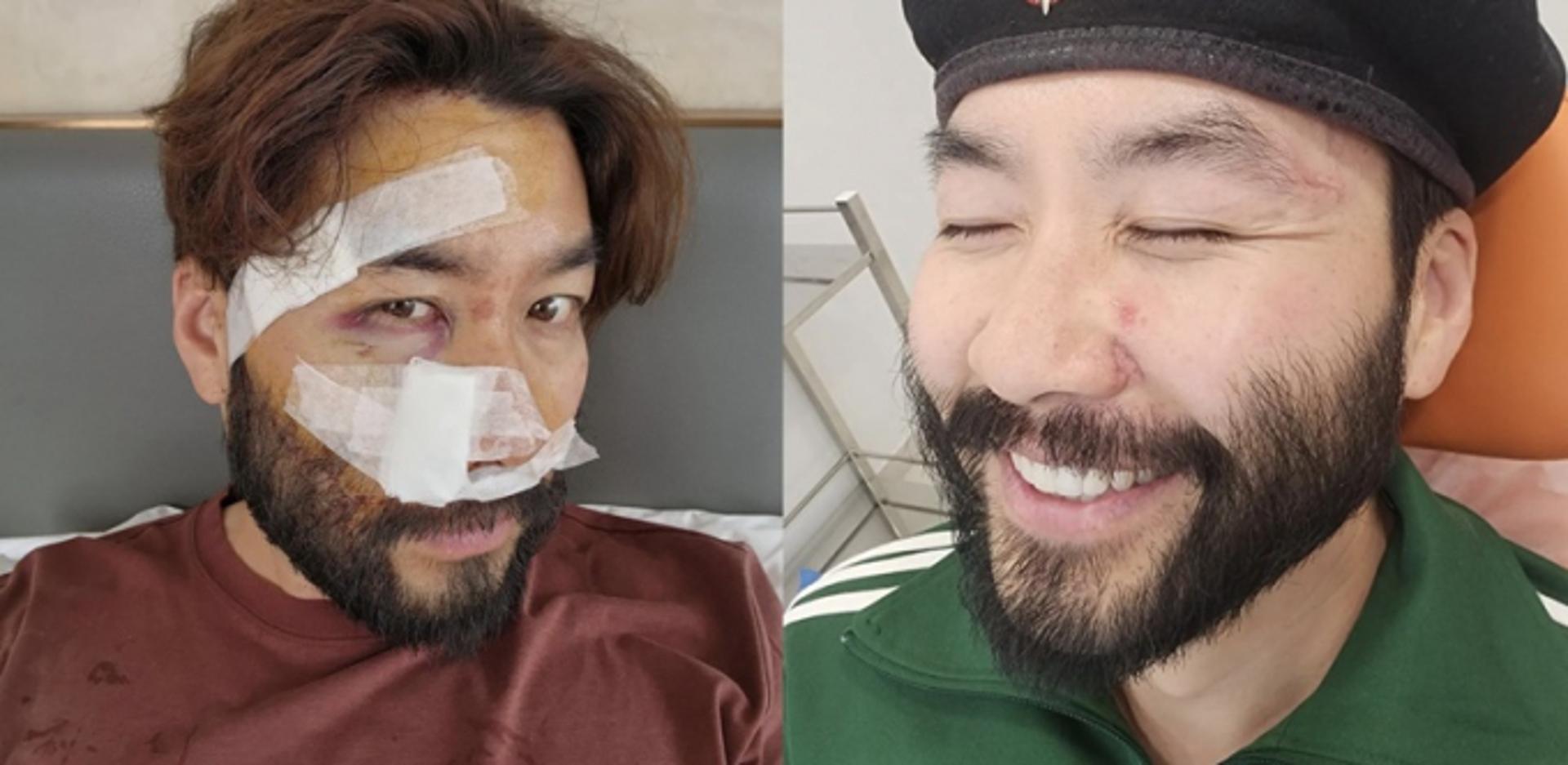 "살이 괴사됐다" 노홍철, 오토바이 사고 심경 밝혀