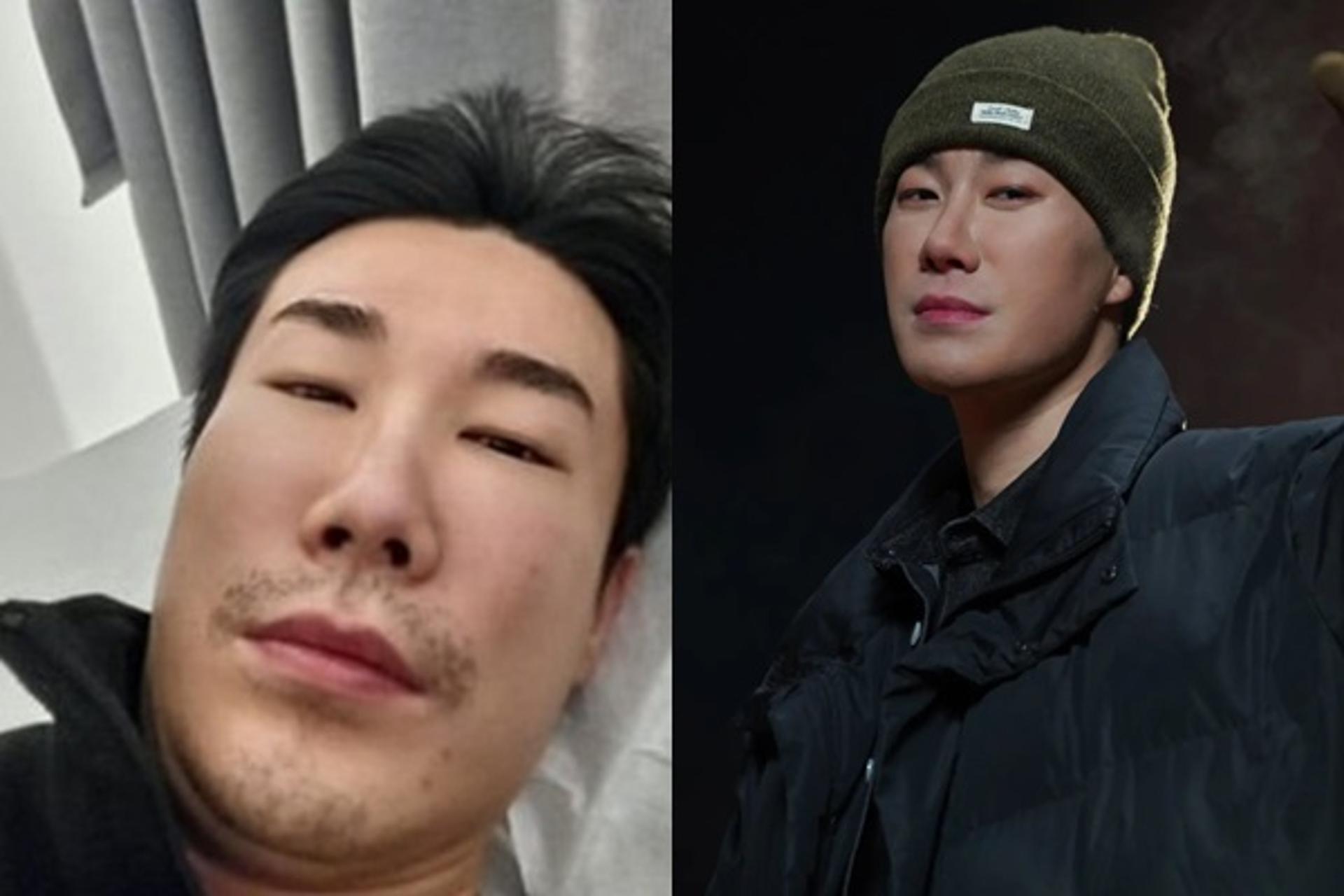 산이, 퉁퉁 부은 얼굴 '깜짝'… 제발회 못간 이유 있었다?