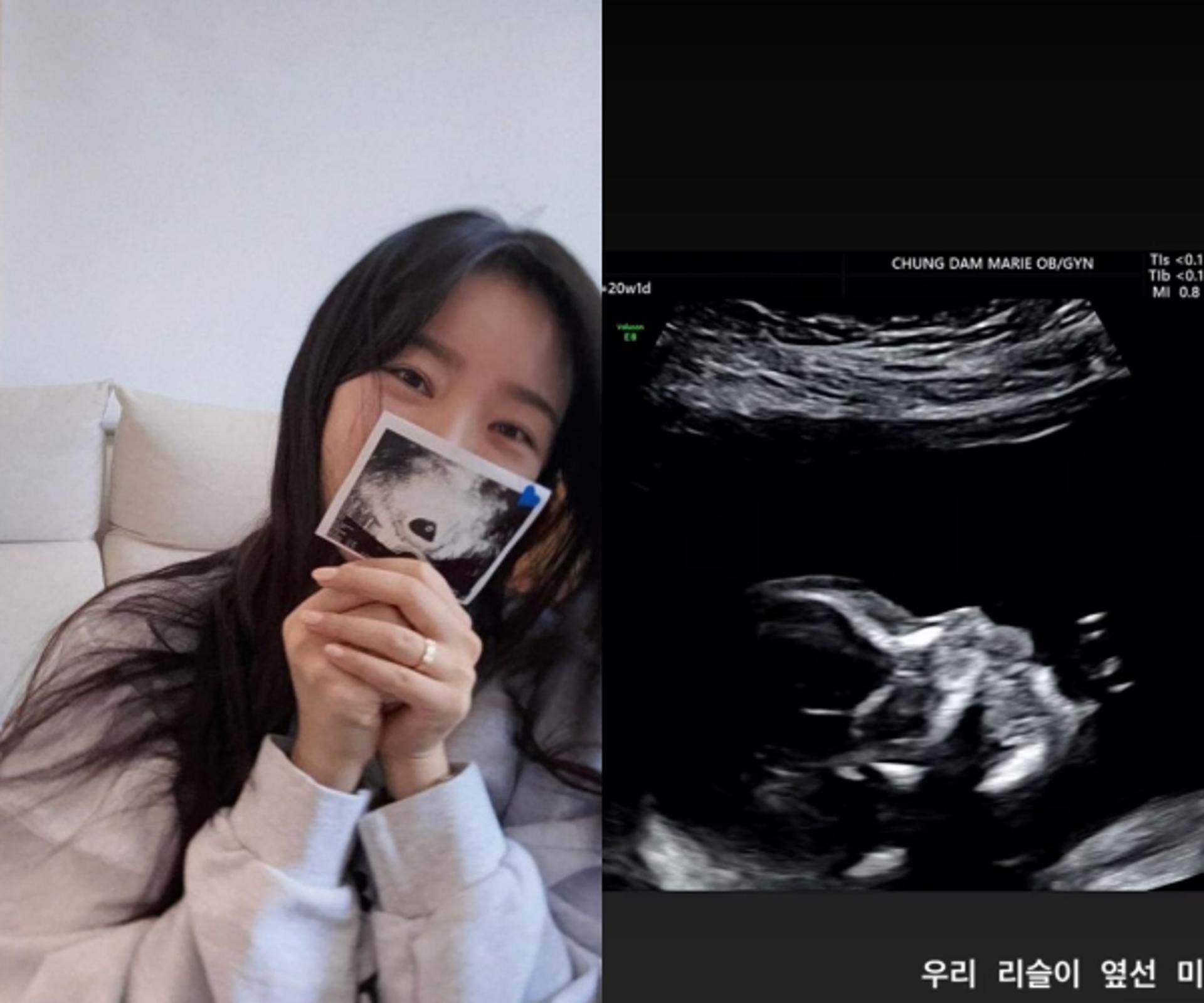 "옆선 미쳤네"… '임신' 배슬기, 초음파 사진 공개