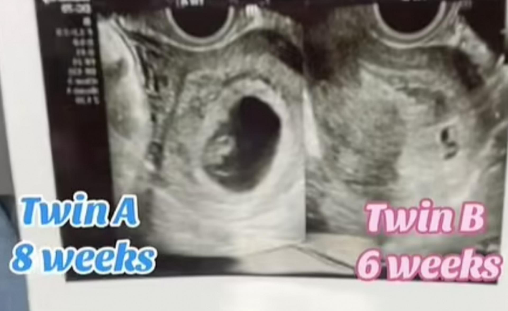 임신 중에 또 임신했다?… 20대 여성, 8주차·6주차 중복임신