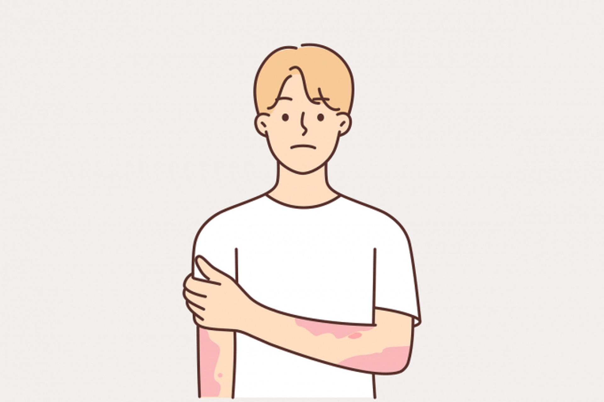[헬스S] "수두 끝난 줄 알았다고요?"