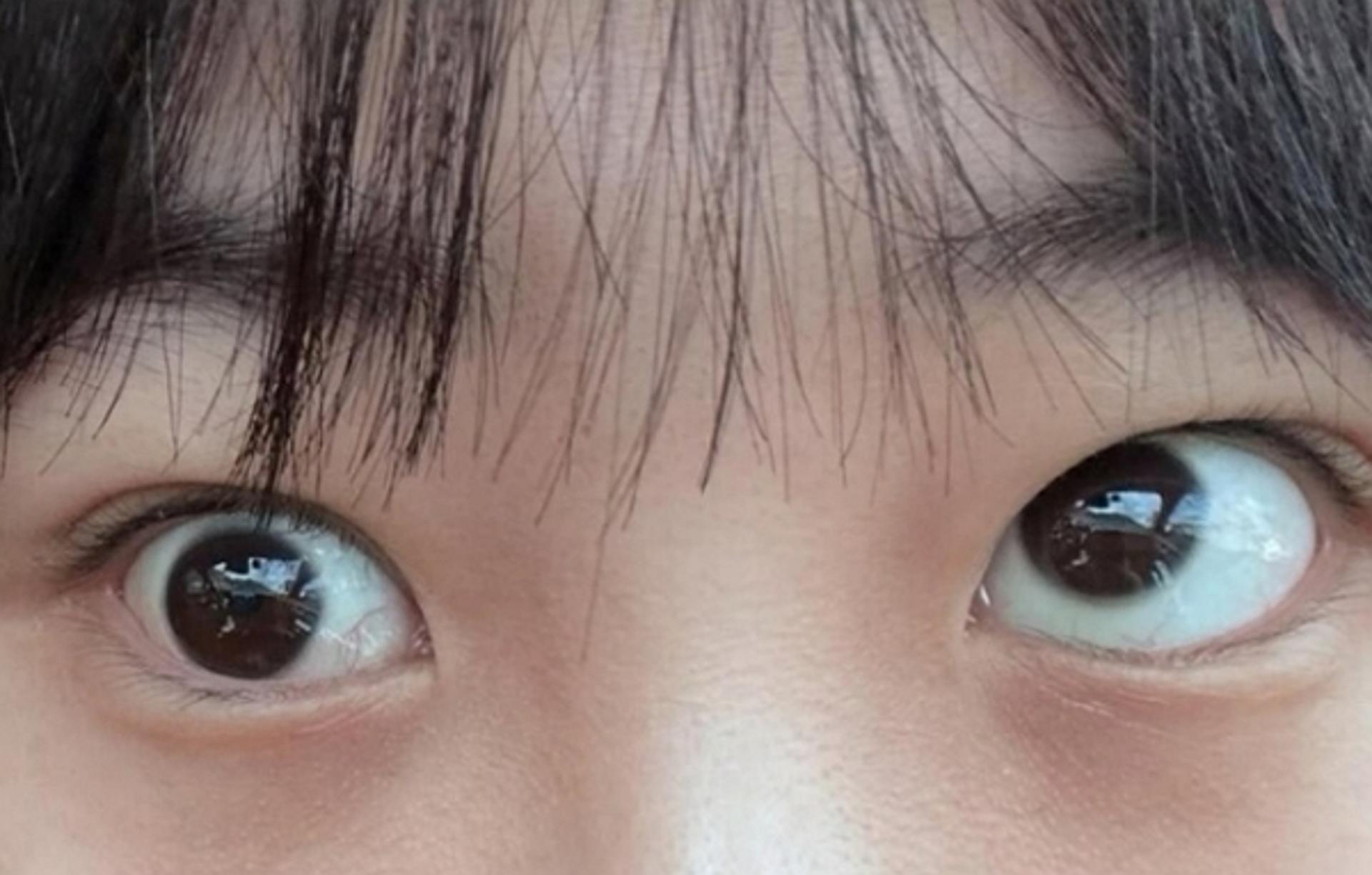 성형수술 후 '사시'된 환자… 공론화하자 병원은 '명예훼손' 고소