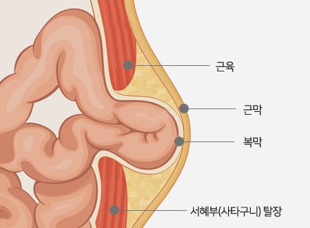 [건강] 기침하다 속 터질 수도… 잦은 기침 탈장 유발