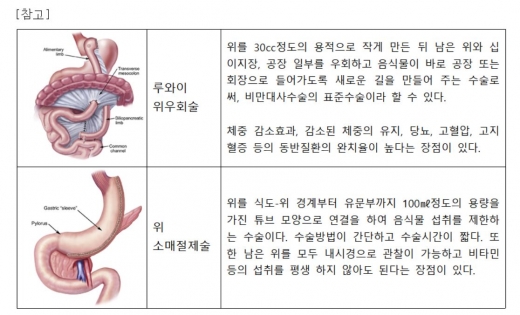 비만대사수술방법 종류 및 설명./사진=여의도성모병원