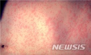 안양 홍역 확산 비상. /사진=뉴시스